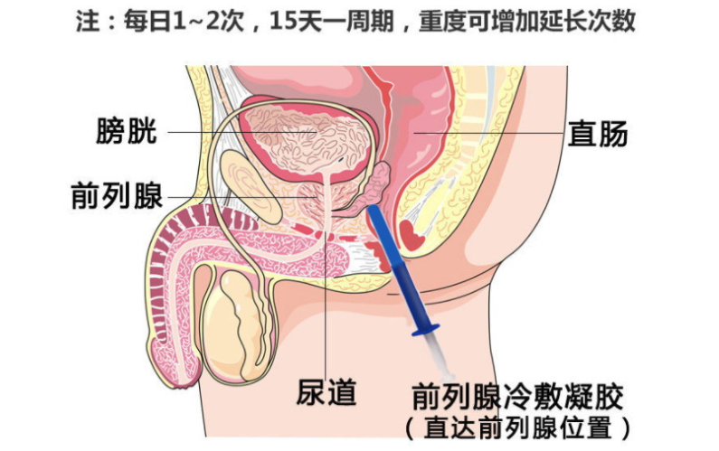 前列腺凝胶的使用.png